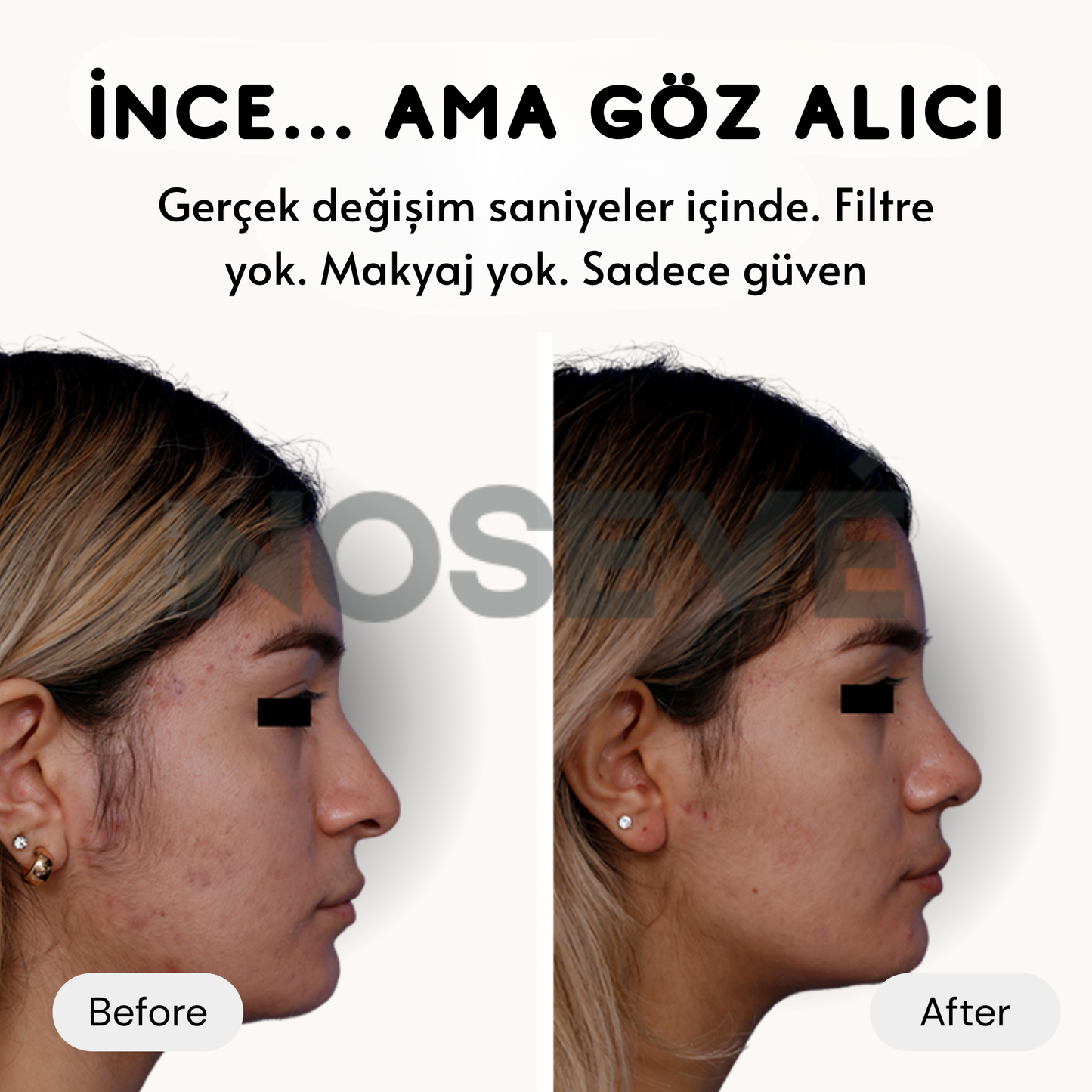 Anında Burun Kaldırma Kiti
